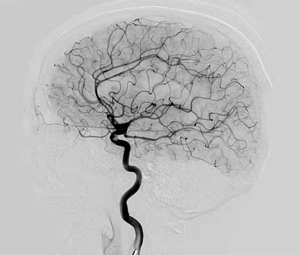 Best Angioplasty Surgeon in Mumbai